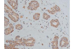 ABIN6268905 at 1/50 staining human breast cancer tissue sections by IHC-P. (OCT4 Antikörper  (Internal Region))