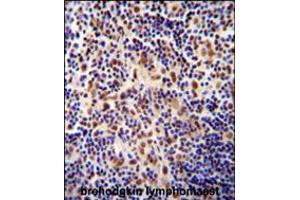 TIGD3 antibody immunohistochemistry analysis in formalin fixed and paraffin embedded human hodgkin lymphoma followed by peroxidase conjugation of the secondary antibody and DAB staining. (TIGD3 Antikörper  (C-Term))