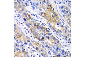 Immunohistochemistry of paraffin-embedded human gastric cancer using BCL2 antibody. (Bcl-2 Antikörper)