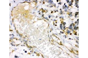 IHC-P: HO-1 antibody testing of human lung cancer tissue (HMOX1 Antikörper  (AA 1-288))