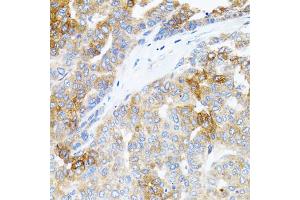 Immunohistochemistry of paraffin-embedded human liver cancer using STAT3 antibody (ABIN1876697) at dilution of 1:100 (40x lens).