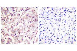 Immunohistochemical analysis of paraffin-embedded human breast carcinoma tissue, using ETS1 (Phospho-Thr38) antibody (left)or the same antibody preincubated with blocking peptide (right). (ETS1 Antikörper  (pThr38))