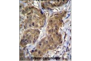RNF11 Antibody (Center) (ABIN656832 and ABIN2846041) immunohistochemistry analysis in formalin fixed and paraffin embedded human breast carcinoma followed by peroxidase conjugation of the secondary antibody and DAB staining. (RNF11 Antikörper  (AA 64-90))