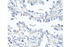 Immunohistochemistry of paraffin-embedded Human lung cancer using P Glycoprotein Polyclonal Antibody at dilution of 1:100 (40x lens). (P-Glycoprotein Antikörper)
