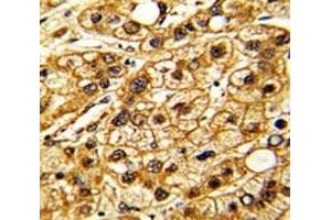 IHC analysis of FFPE human hepatocarcinoma stained with CD11c antibody (CD11c Antikörper  (AA 1119-1145))