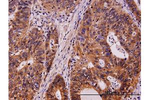 Immunoperoxidase of monoclonal antibody to KIT on formalin-fixed paraffin-embedded human stomach carcinoma.