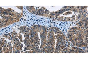 Immunohistochemistry of paraffin-embedded Human ovarian cancer tissue using SYT3 Polyclonal Antibody at dilution 1:40 (Synaptotagmin 3 Antikörper)