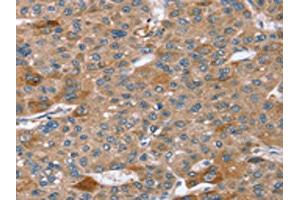 The image on the left is immunohistochemistry of paraffin-embedded Human liver cancer tissue using ABIN7192629(SPATA5L1 Antibody) at dilution 1/20, on the right is treated with synthetic peptide. (SPATA5L1 Antikörper)
