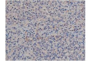ABIN6267357 at 1/200 staining Human ganstric cancer tissue sections by IHC-P. (MAPT Antikörper  (pSer422))