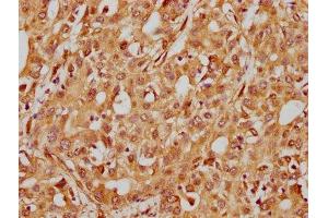 IHC image of ABIN7127584 diluted at 1:185 and staining in paraffin-embedded human liver cancer performed on a Leica BondTM system. (Rekombinanter ITGB1 Antikörper)