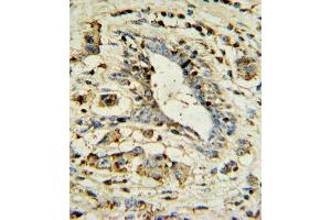 OL1 Antibody 7361a IHC analysis in formalin fixed and paraffin embedded human breast carcinoma followed by peroxidase conjugation of the secondary antibody and DAB staining.