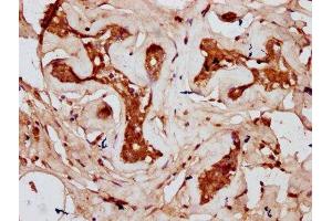 IHC image of ABIN7148040 diluted at 1:300 and staining in paraffin-embedded human breast cancer performed on a Leica BondTM system.