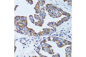 Immunohistochemistry of paraffin-embedded human gastric cancer using GIP antibody. (GIP Antikörper)