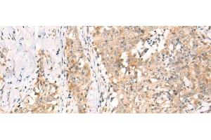 Immunohistochemistry of paraffin-embedded Human esophagus cancer tissue using YRDC Polyclonal Antibody at dilution of 1:30(x200) (YRDC Antikörper)