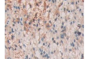 Detection of SHC3 in Human Glioma Tissue using Polyclonal Antibody to SHC-Transforming Protein 3 (SHC3) (SHC3 Antikörper  (AA 188-433))