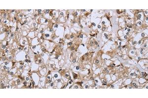 Immunohistochemistry of paraffin-embedded Human prostate cancer using CD32 Polyclonal Antibody at dilution of 1:40 (Fc gamma RII (CD32) Antikörper)