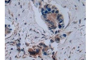 Detection of C2CD3 in Human Breast cancer Tissue using Polyclonal Antibody to C2 Calcium Dependent Domain Containing Protein 3 (C2CD3) (C2CD3 Antikörper  (AA 1432-1647))
