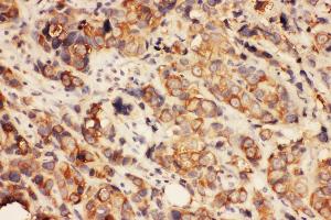 Anti-HDAC2 antibody,  IHC(P) IHC(P): Human Mammary Cancer Tissue