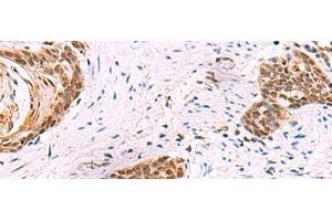 Immunohistochemistry of paraffin-embedded Human esophagus cancer tissue using CREBBP Polyclonal Antibody at dilution of 1:35(x200) (CBP Antikörper)