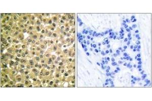 Immunohistochemistry analysis of paraffin-embedded human breast carcinoma tissue, using Retinoic Acid Receptor beta Antibody. (Retinoic Acid Receptor beta Antikörper  (AA 331-380))