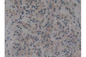 IHC-P analysis of Human Prostate cancer Tissue, with DAB staining. (NUP153 Antikörper  (AA 1238-1468))