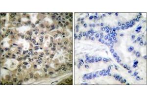 Immunohistochemistry analysis of paraffin-embedded human lung carcinoma, using IkappaB-beta (Phospho-Ser23) Antibody.
