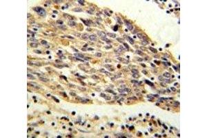 PKM2 antibody IHC analysis in formalin fixed and paraffin embedded human lung carcinoma. (PKM2 Antikörper  (AA 116-145))