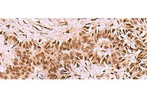 Immunohistochemistry of paraffin-embedded Human ovarian cancer tissue using LDB1 Polyclonal Antibody at dilution of 1:70(x200) (LIM Domain Binding 1 Protein Antikörper)