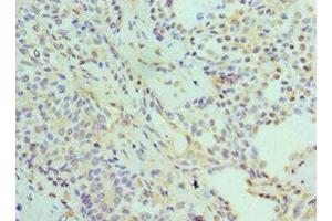 Immunohistochemistry of paraffin-embedded human breast cancer using ABIN7142216 at dilution of 1:100 (PSMD5 Antikörper  (Regulatory Subunit 5))