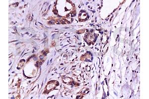 Formalin-fixed and paraffin embedded human gastric carcinoma labeled with Anti-CD105 Polyclonal Antibody (ABIN670401), Unconjugated at 1:200, followed by conjugation to the secondary antibody and DAB staining (Endoglin Antikörper  (AA 601-658))