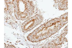IHC-P Image Immunohistochemical analysis of paraffin-embedded human colon carcinoma, using EIF2B beta, antibody at 1:250 dilution. (eIF2B beta (Center) Antikörper)