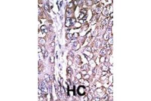 Formalin-fixed and paraffin-embedded human cancer tissue reacted with the primary antibody, which was peroxidase-conjugated to the secondary antibody, followed by AEC staining. (ATG4A Antikörper  (AA 82-111))