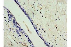 Immunohistochemistry of paraffin-embedded human breast cancer using ABIN7146735 at dilution of 1:100 (CA8 Antikörper  (AA 1-290))
