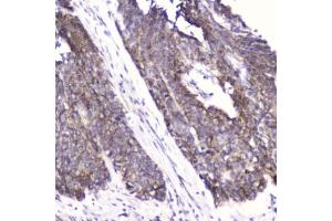 IHC testing of FFPE human esophageal squamous cell carcinoma with FABP3 antibody at 2ug/ml. (FABP3 Antikörper  (AA 2-133))