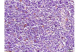 Formalin-fixed and paraffin embedded human pancreatic cancer tissue labeled with Anti-CD1A Polyclonal Antibody, Unconjugated (ABIN702700) at 1:200 followed by conjugation to the secondary antibody and DAB staining (CD1d1 Antikörper  (AA 51-150))
