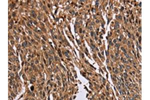 The image on the left is immunohistochemistry of paraffin-embedded Human lung cancer tissue using ABIN7129718(HMGN5 Antibody) at dilution 1/20, on the right is treated with fusion protein. (HMGN5 Antikörper)
