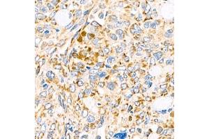 Immunohistochemistry analysis of paraffin-embedded human ovary cancer using Torsin A (ABIN7075942) at dilution of 1:800 (TOR1A Antikörper)