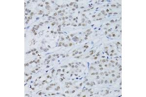 Immunohistochemistry of paraffin-embedded human colon carcinoma using SNRNP70 antibody. (SNRNP70 Antikörper  (AA 150-250))