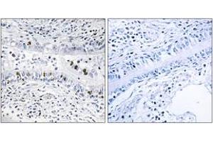 Immunohistochemistry analysis of paraffin-embedded human lung carcinoma tissue, using EZH1 Antibody. (EZH1 Antikörper  (AA 171-220))