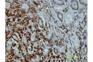 Immunoperoxidase of monoclonal antibody to STK4 on formalin-fixed paraffin-embedded human stomach carcinoma tissue. (STK4 Antikörper  (AA 1-39))