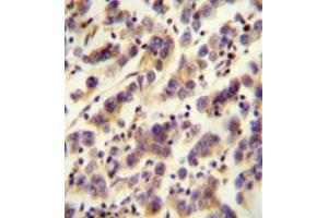Immunohistochemistry analysis in formalin fixed and paraffin embedded human testis carcinoma reacted with OR1J4 Antibody (C-term) followed which was peroxidase conjugated to the secondary antibody and followed by DAB staining. (OR1J4 Antikörper  (C-Term))