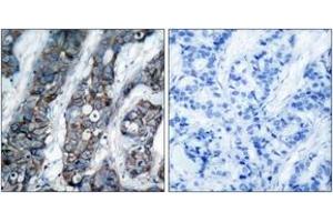 Immunohistochemistry analysis of paraffin-embedded human breast carcinoma, using HER2 (Phospho-Tyr1248) Antibody. (ErbB2/Her2 Antikörper  (pTyr1248))