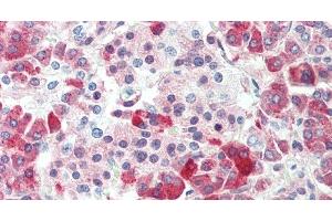 Immunohistochemistry of paraffin-embedded Human gastric cancer using CPB1 Polyclonal Antibody at dilution of 1:60. (CPB1 Antikörper)