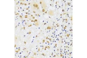 Immunohistochemistry of paraffin-embedded human liver cancer using HNRNPA1 Antibody (ABIN5975570) at dilution of 1/100 (40x lens). (HNRNPA1 Antikörper)
