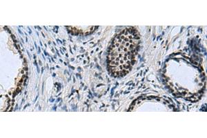 Immunohistochemistry of paraffin-embedded Human prost at e cancer tissue using CCAR2 Polyclonal Antibody at dilution of 1:40(x200) (CCAR2 Antikörper)