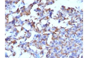 Formalin-fixed, paraffin-embedded human Histiocytoma stained with CD163-Monospecific Mouse Monoclonal Antibody (M130/2162).