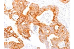 Formalin-fixed, paraffin-embedded human Colorectal Carcinoma stained with Ep-CAM Mouse Monoclonal Antibody (EGP40/1798). (EpCAM Antikörper  (Extracellular Domain))