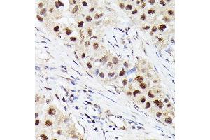Immunohistochemistry of paraffin-embedded human breast cancer using [KO Validated] CDK4 Rabbit mAb  at dilution of 1:100 (40x lens). (CDK4 Antikörper)