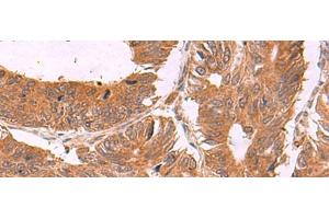 Immunohistochemistry of paraffin-embedded Human colorectal cancer tissue using ZBTB33 Polyclonal Antibody at dilution of 1:30(x200)