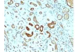 Formalin-fixed, paraffin-embedded human Renal Cell Carcinoma stained with STAT3 Mouse Monoclonal Antibody (STAT3/2409). (STAT3 Antikörper)